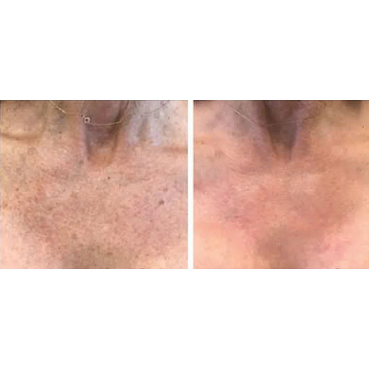 Blemish & Hair Removal Device - Image 3