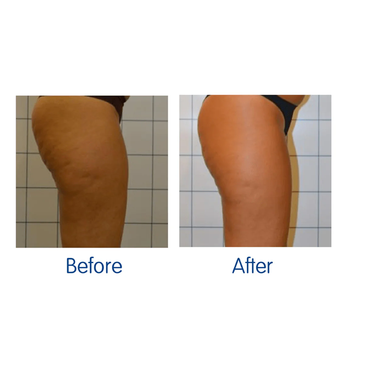 LED Cellulite Reducing Device - Image 4