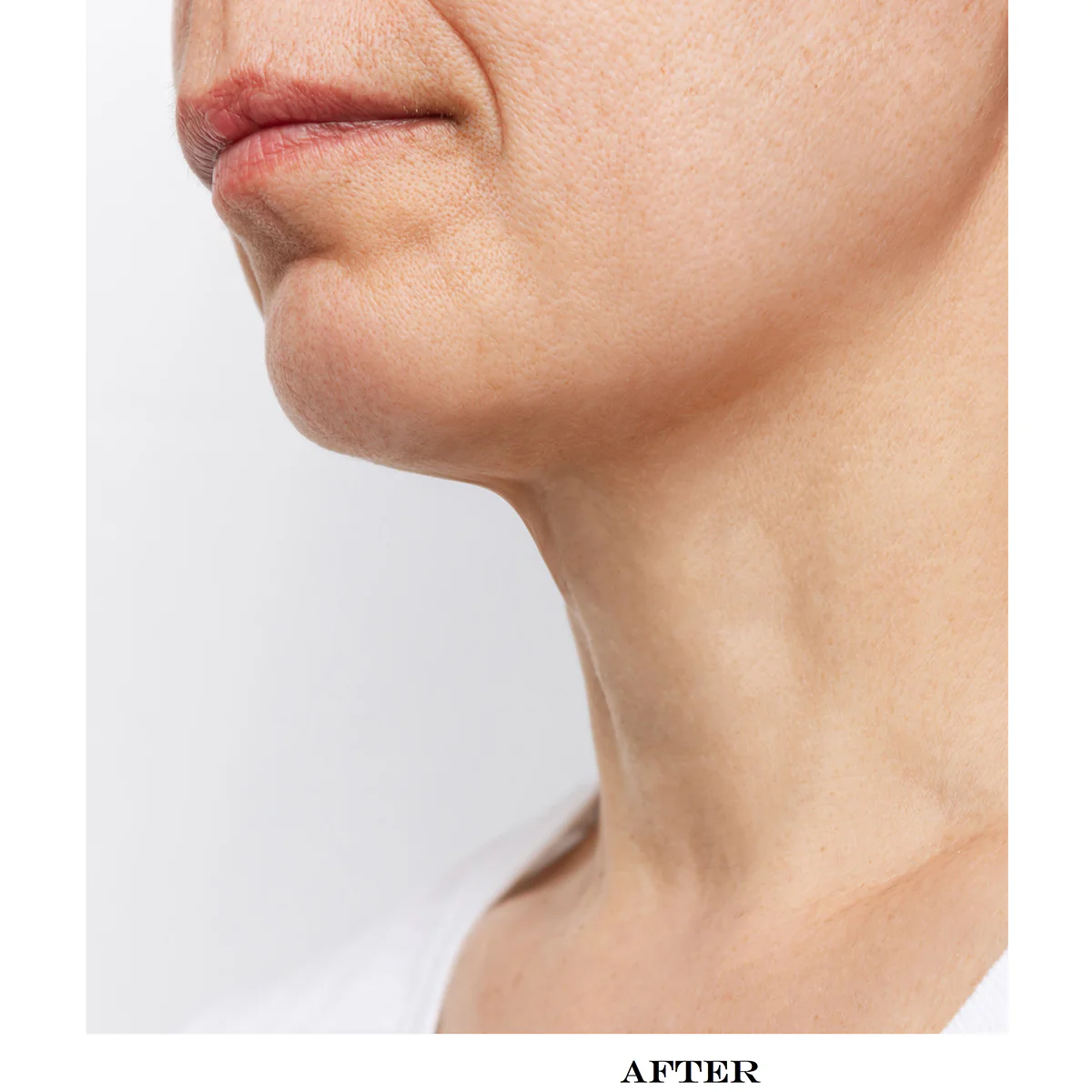 Wrinkle Reducing Neck Therapy Device - Image 6